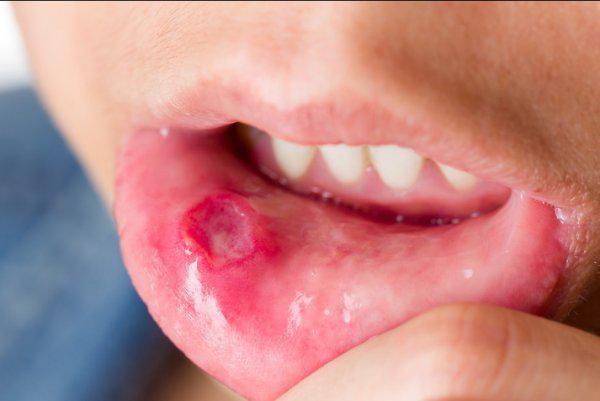 口腔溃疡最怕3种水果？口腔溃疡最怕三种水果？-第3张图片-爱游哥学习网