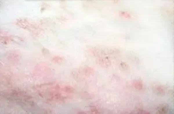 细菌性皮肤病是如何引起的呢？细菌性皮肤病的种类有哪些？-第14张图片-爱游哥学习网