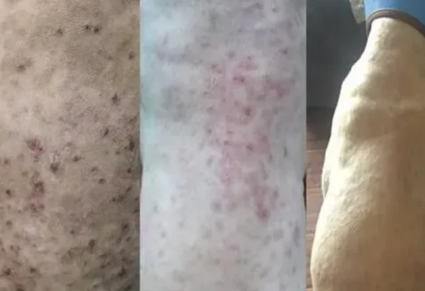 细菌性皮肤病是如何引起的呢？细菌性皮肤病的种类有哪些？-第6张图片-爱游哥学习网