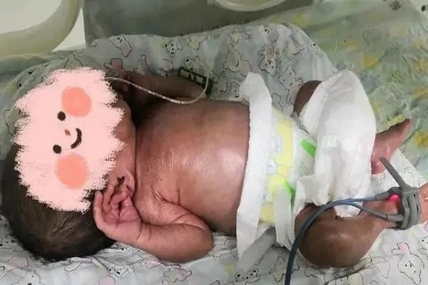 火胶棉婴儿胶图片 火胶棉体婴儿图片 火棉胶婴儿恐怖图