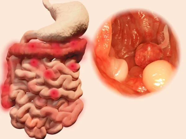 大便不成形粘马桶还臭是什么原因-第9张图片-爱游哥学习网